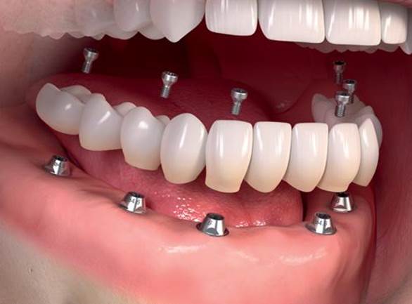 کامپوزیت دندان 